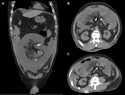 A prediction model to differentiate transient ischemia from irreversible transmural necrosis in closed-loop small bowel obstruction